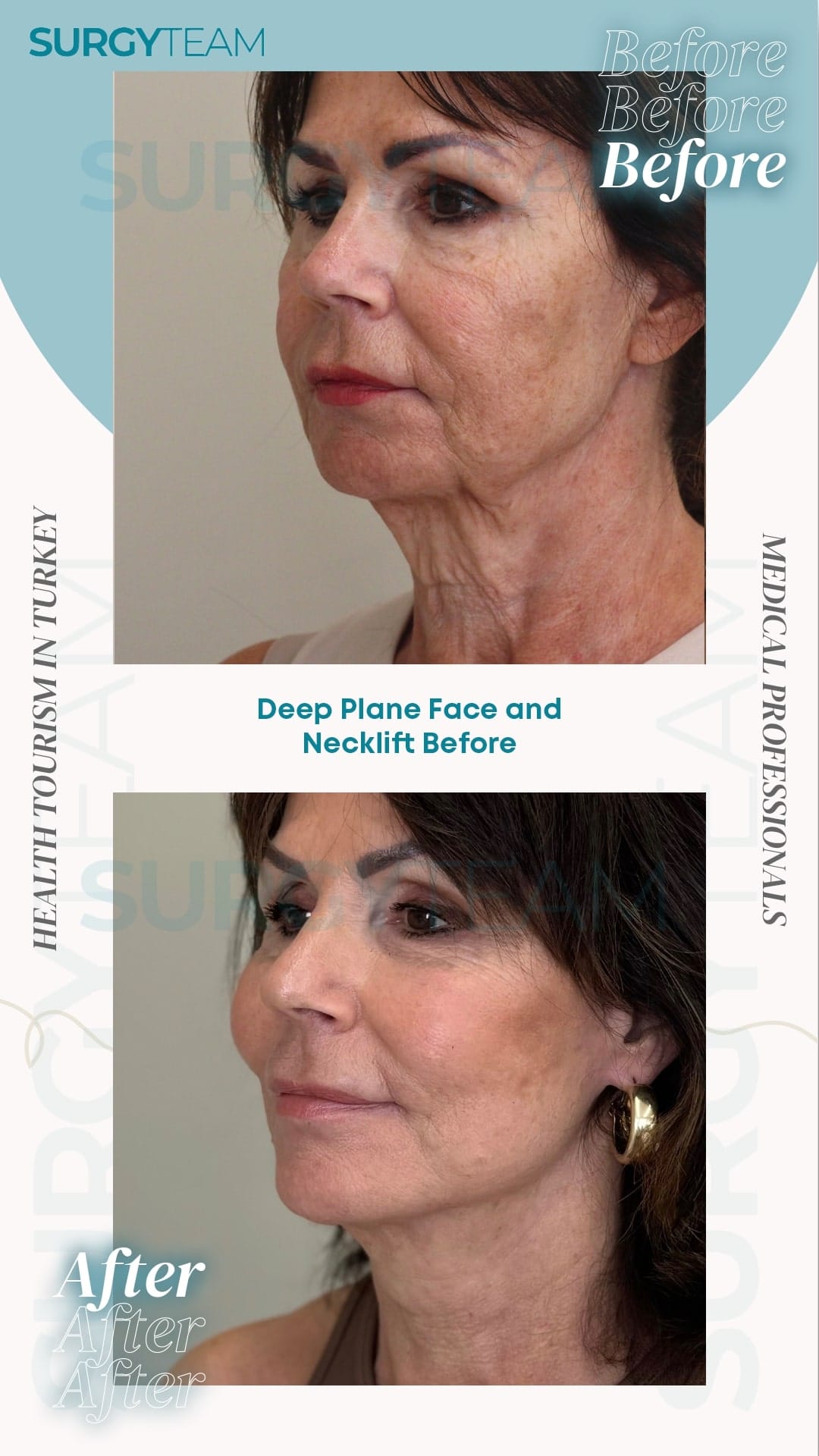 Before and after photos of a woman who underwent a deep plane face and neck lift procedure in Turkey. The 'before' image shows signs of aging such as sagging skin and wrinkles, while the 'after' image displays a rejuvenated appearance with tighter skin and reduced wrinkles.