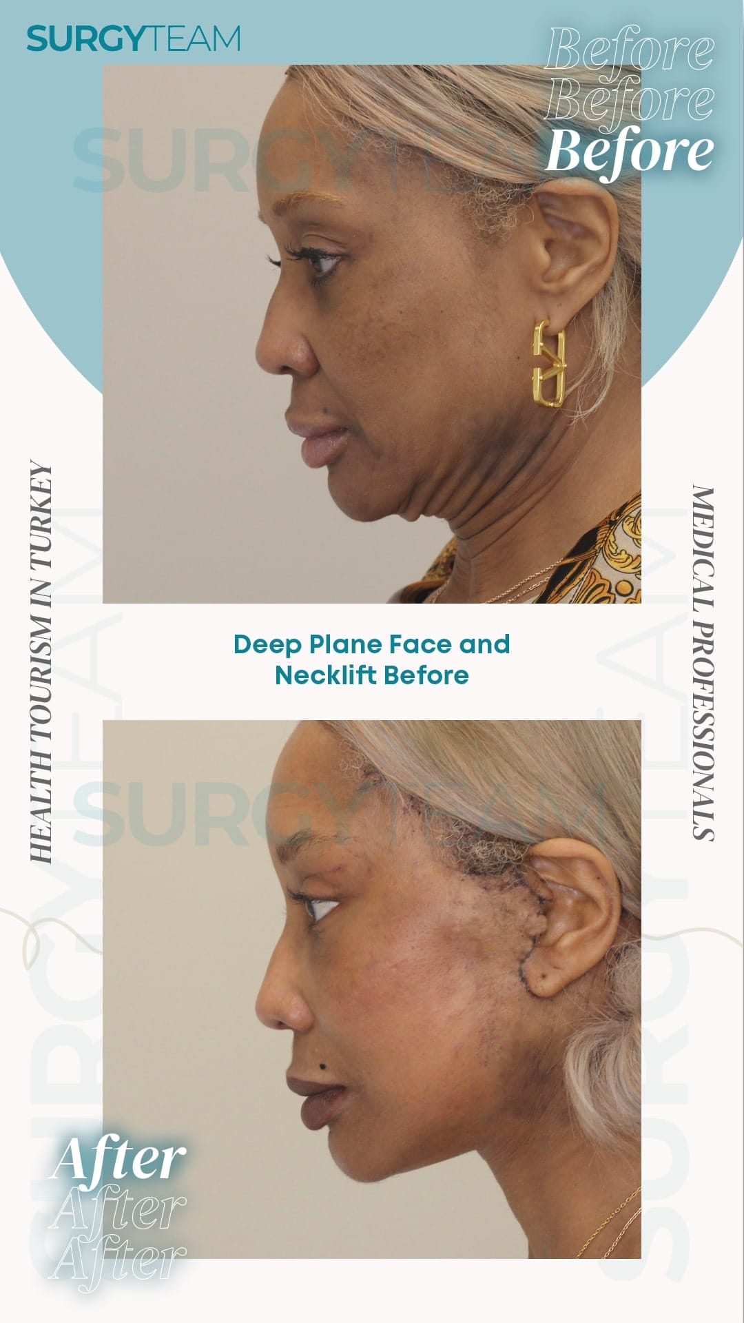 Before and after photos showing the results of a deep plane face and neck lift procedure. The 'before' image displays the patient's face and neck with visible signs of aging, while the 'after' image shows the improved appearance following the surgery.