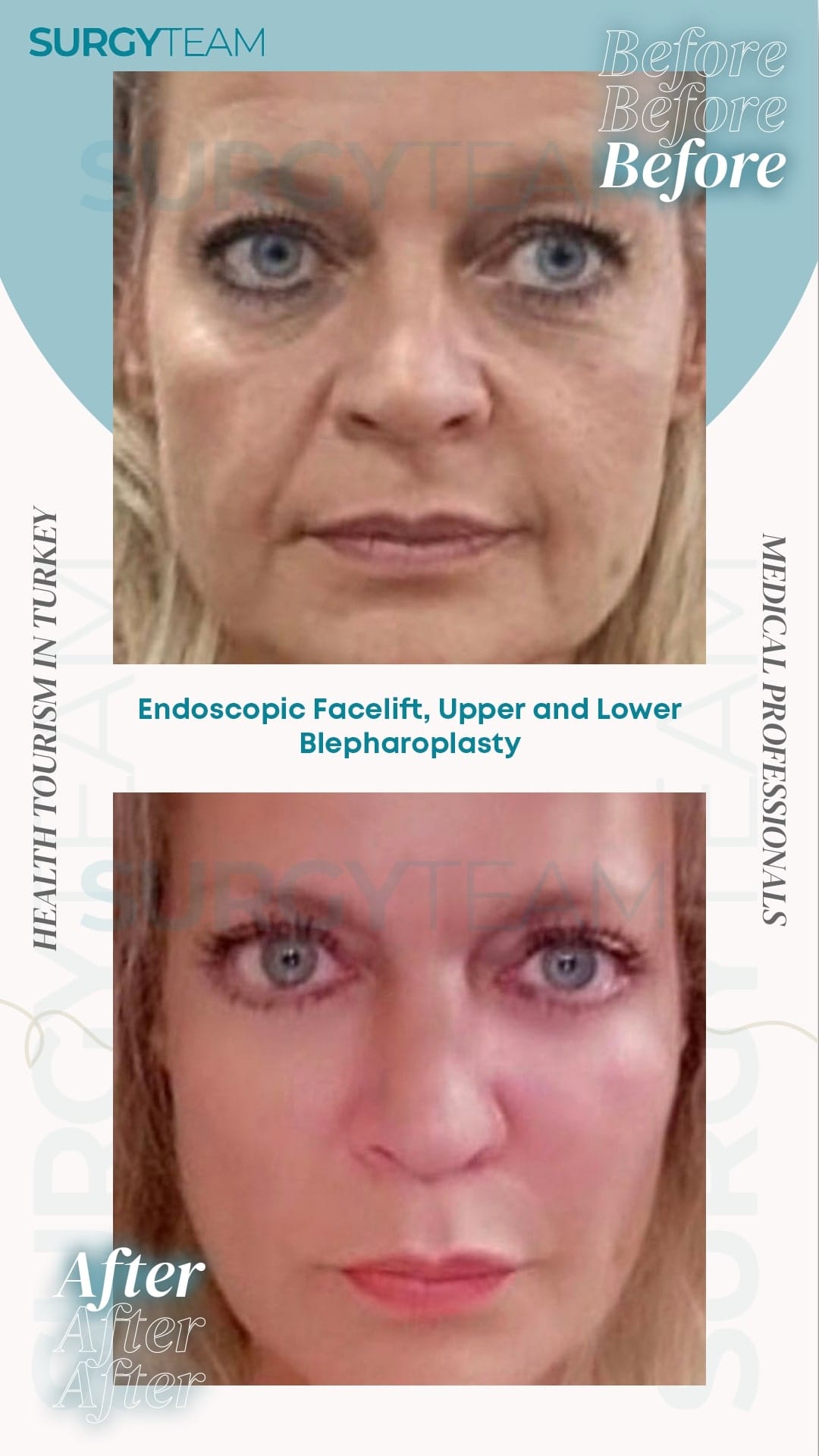 Before and after photos of a patient who underwent endoscopic facelift, upper and lower blepharoplasty performed by medical professionals at SurgyTeam in Turkey.