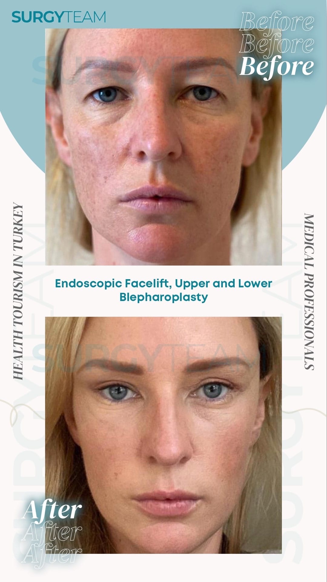 Before and after photos of a patient who underwent endoscopic facelift, upper and lower blepharoplasty in Turkey. The images show the patient's face before and after the procedure, highlighting the changes and improvements in facial appearance.