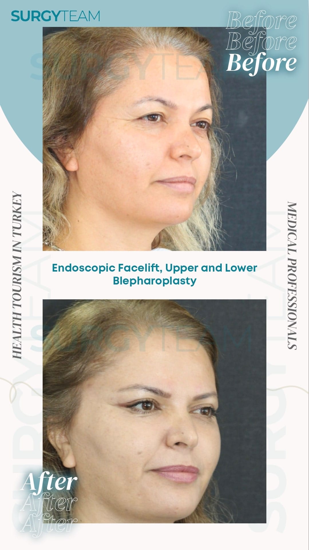 Before and after photos of a patient who underwent endoscopic facelift, upper and lower blepharoplasty, showcasing the results of the procedure performed by medical professionals in Turkey.