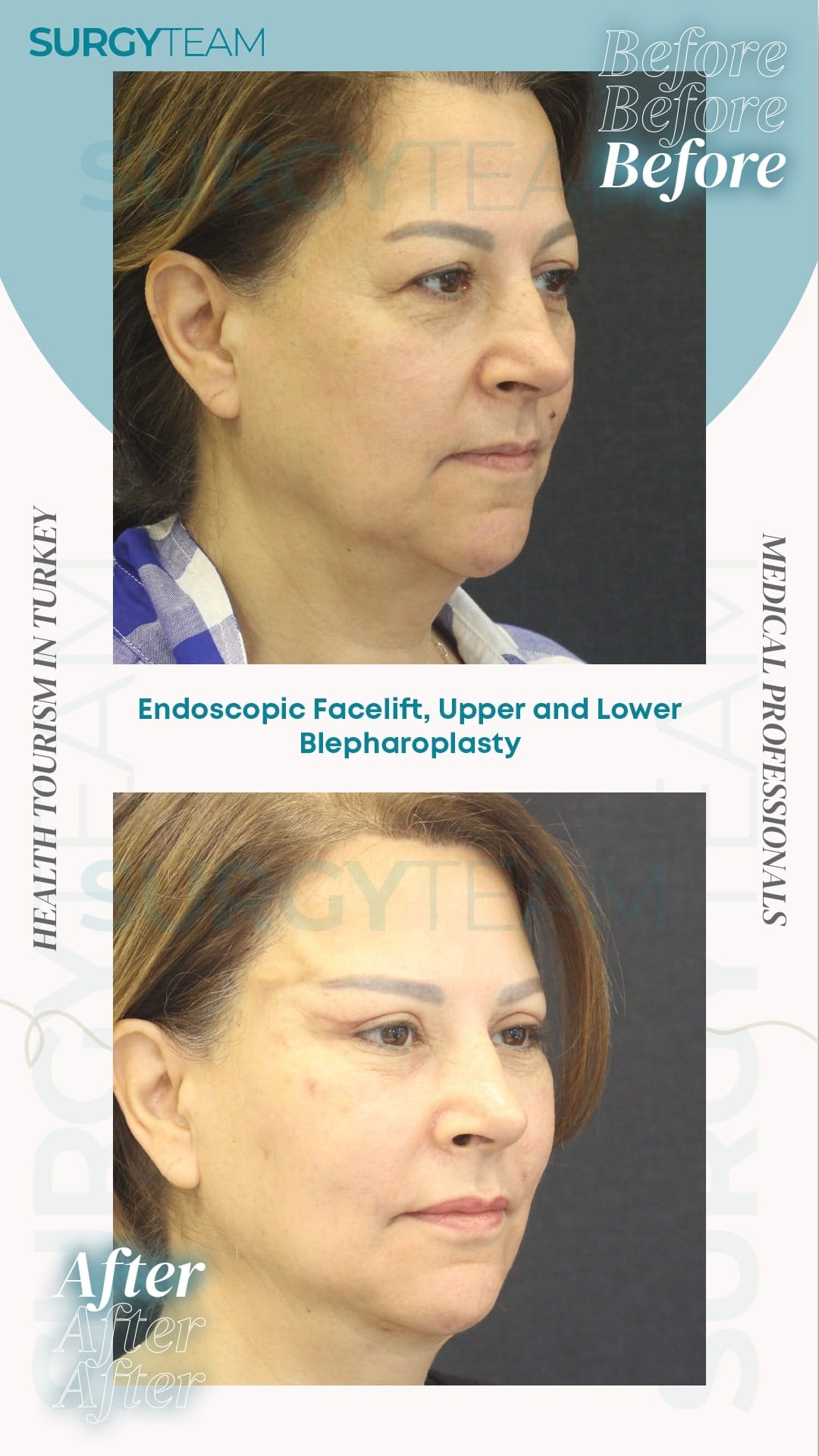 Before and after photos of a patient who underwent endoscopic facelift, upper and lower blepharoplasty in Turkey. The images show the patient's face before and after the procedure, highlighting the changes and improvements.
