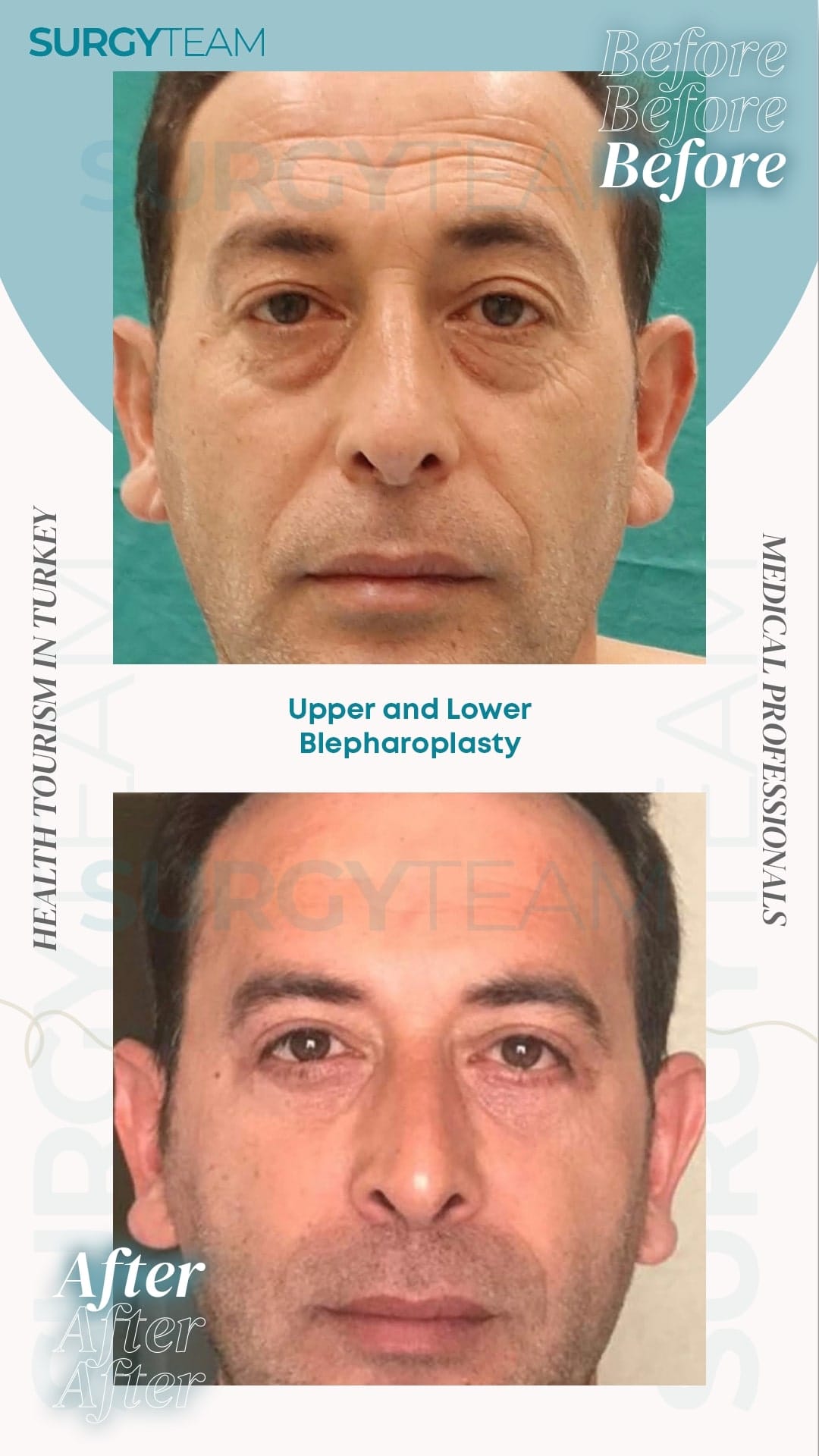 Before and after photos of a man who has undergone upper and lower blepharoplasty, a surgical procedure to remove excess skin and fat from around the eyes, showcasing the results of the surgery.