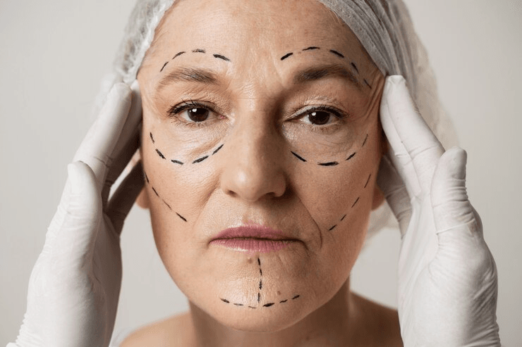 What is the recovery time for a facelift