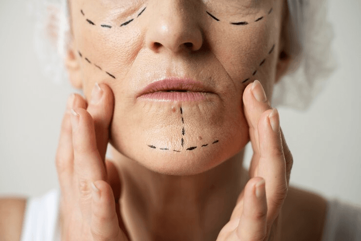 What is the recovery time for a facelift? 1