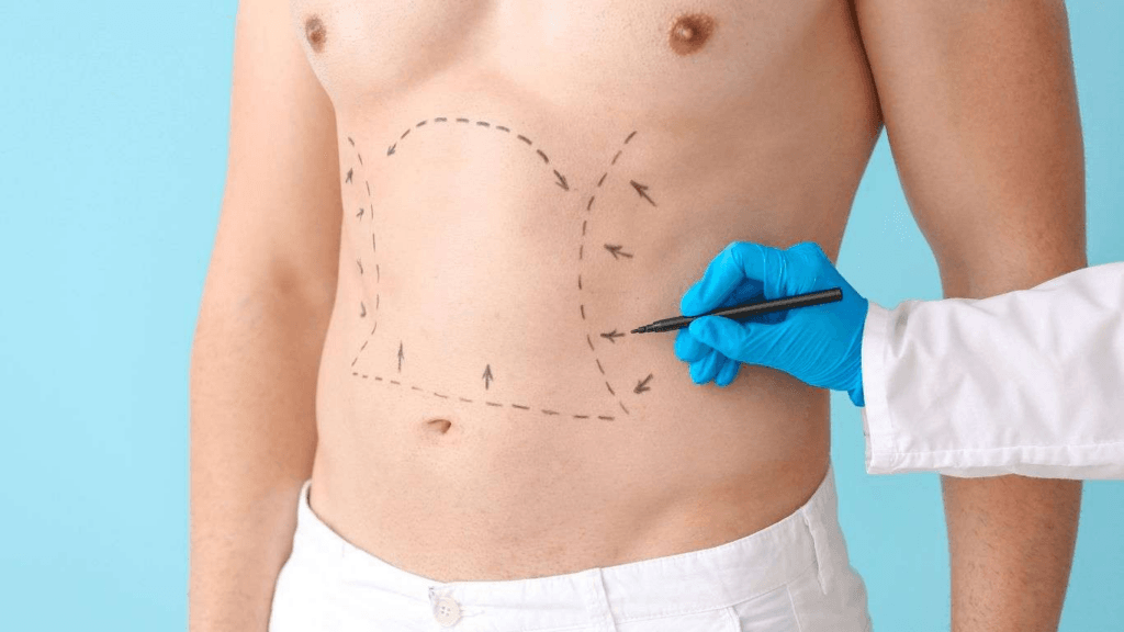 Domande frequenti sull'addominoplastica 3