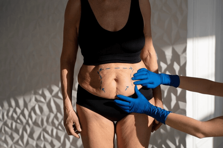 Стоимость операции по подтяжке живота в Анталии 1