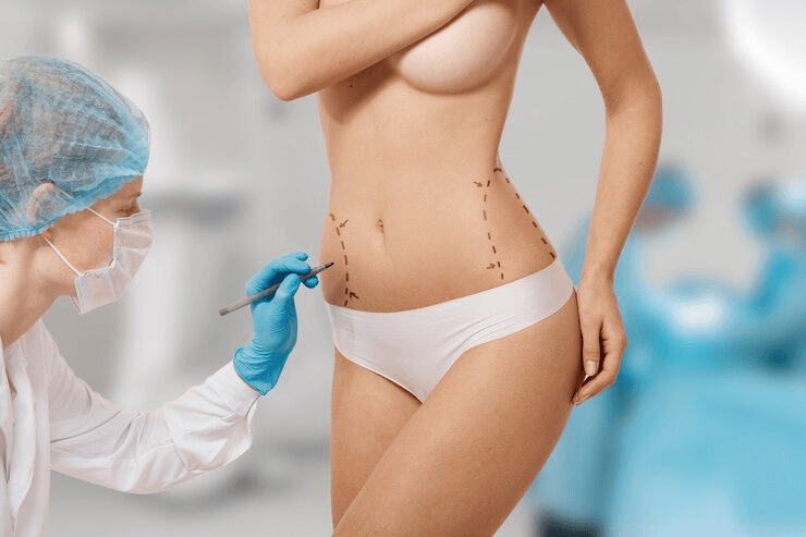 A surgeon, wearing a mask and gloves, marks the abdomen of a patient in preparation for a cosmetic surgery procedure.