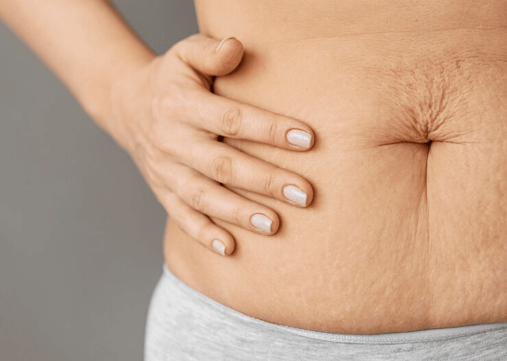 Что происходит с подтяжкой живота с возрастом? 1