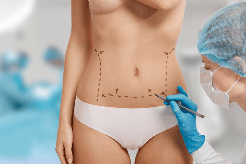 tummy liposuction