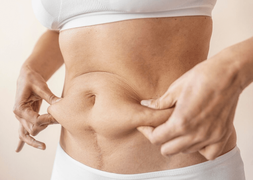 tummy liposuction
