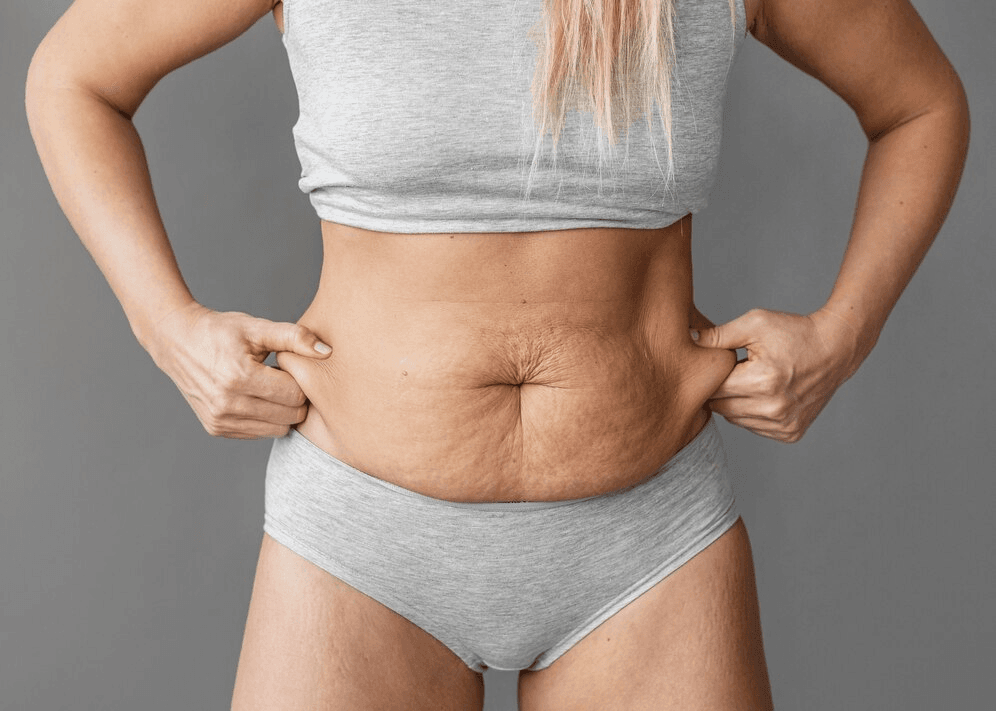 tummy tuck