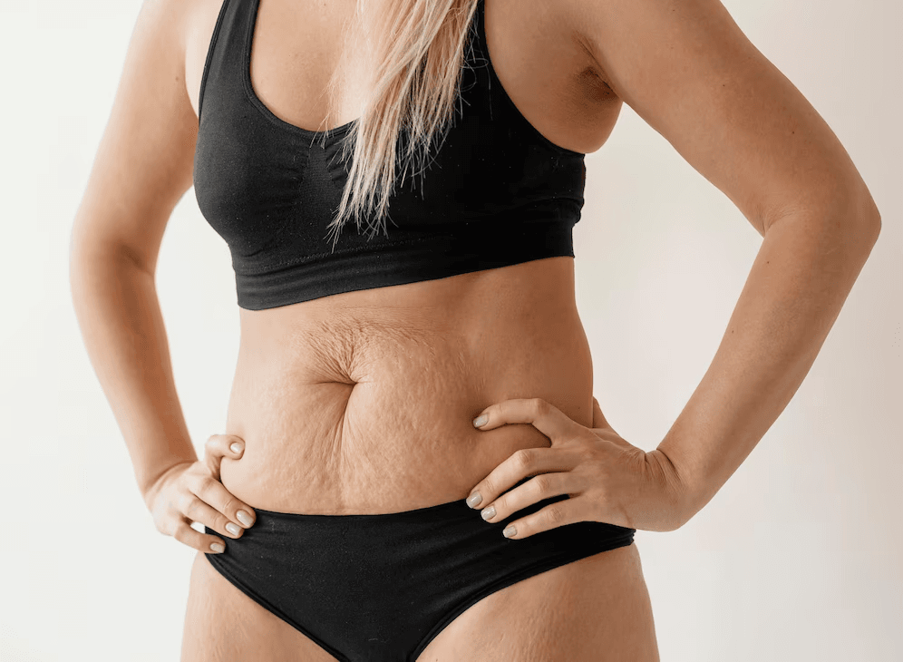 How many sizes did you go down after tummy tuck? 1
