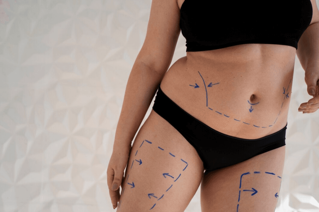 liposuction