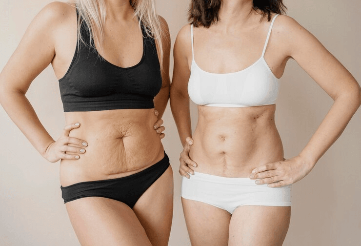 What is the ideal weight for liposuction? 2