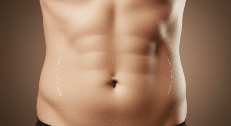 A close-up image of a person's abdomen with visible markings indicating areas for potential liposuction or surgical intervention. The markings highlight specific regions on either side of the navel.