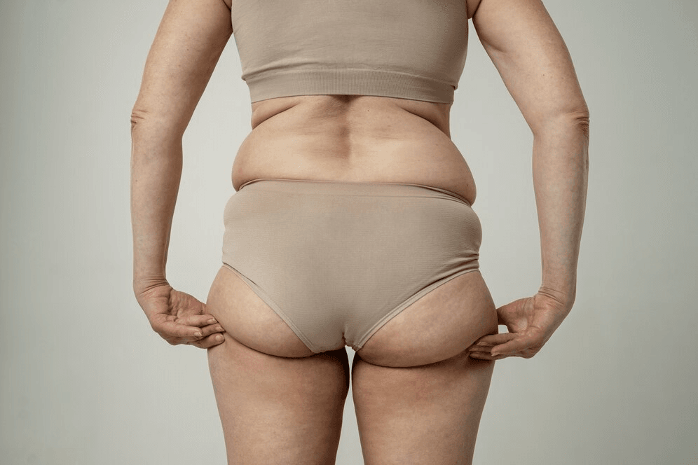 Can you lose 100 pounds with liposuction? 2