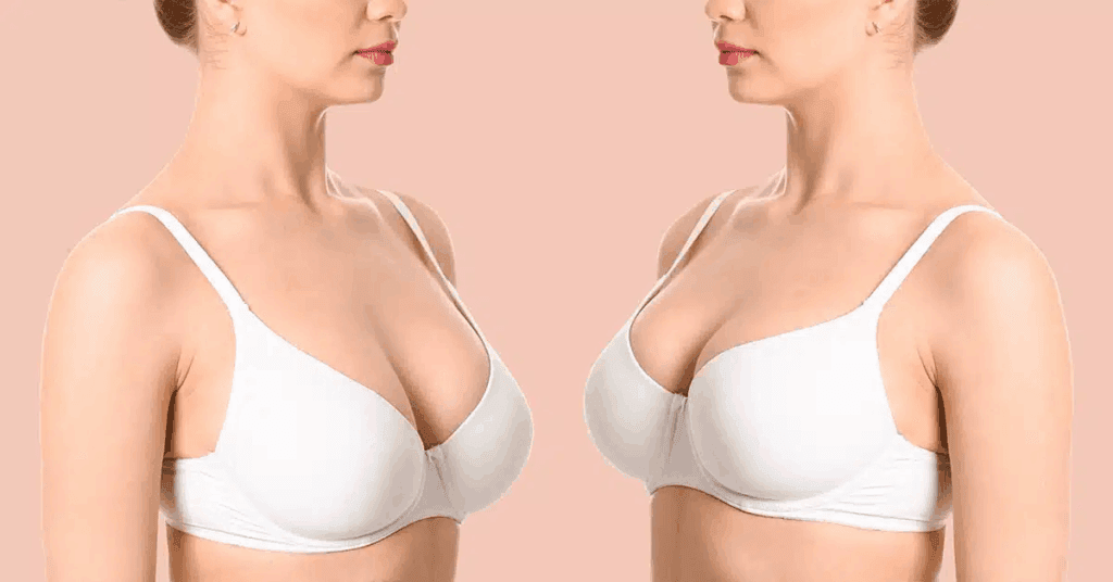 Best Country for Breast Surgery Abroad: 2025 Expert Guide & Costs 1