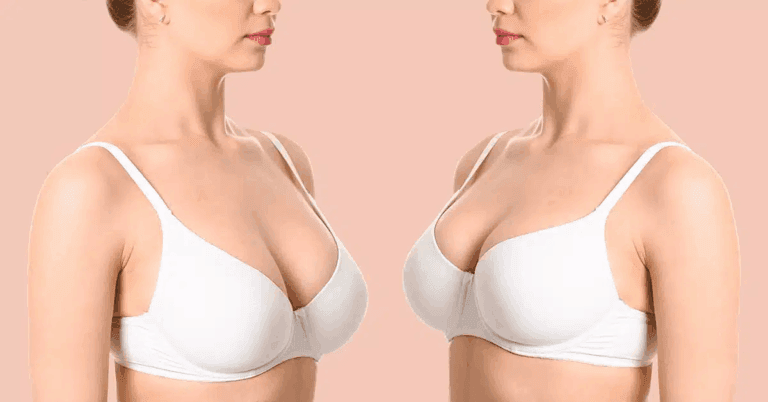 Before and after comparison image of a woman wearing a white bra, shown from the side, highlighting changes in breast appearance.