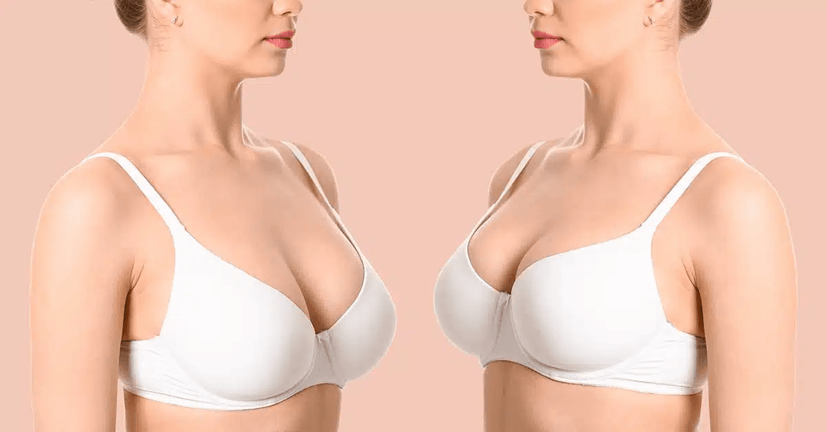 Before and after comparison image of a woman wearing a white bra, shown from the side, highlighting changes in breast appearance.