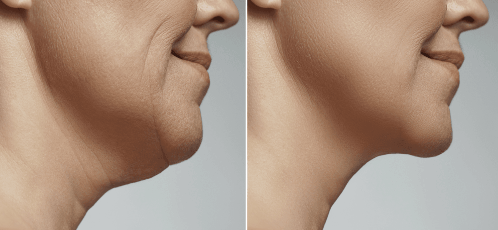 Traditional vs. Minimally Invasive Facelifts Abroad: 2025 Guide 1