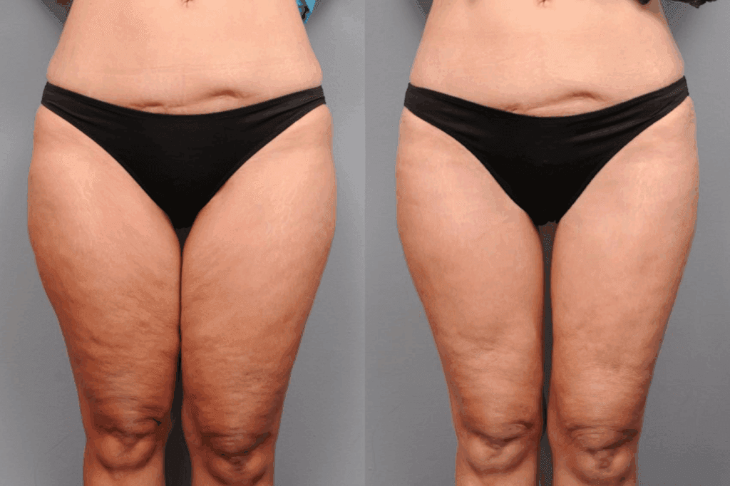 Realistic Thighplasty Results: What to Expect & Longevity 1