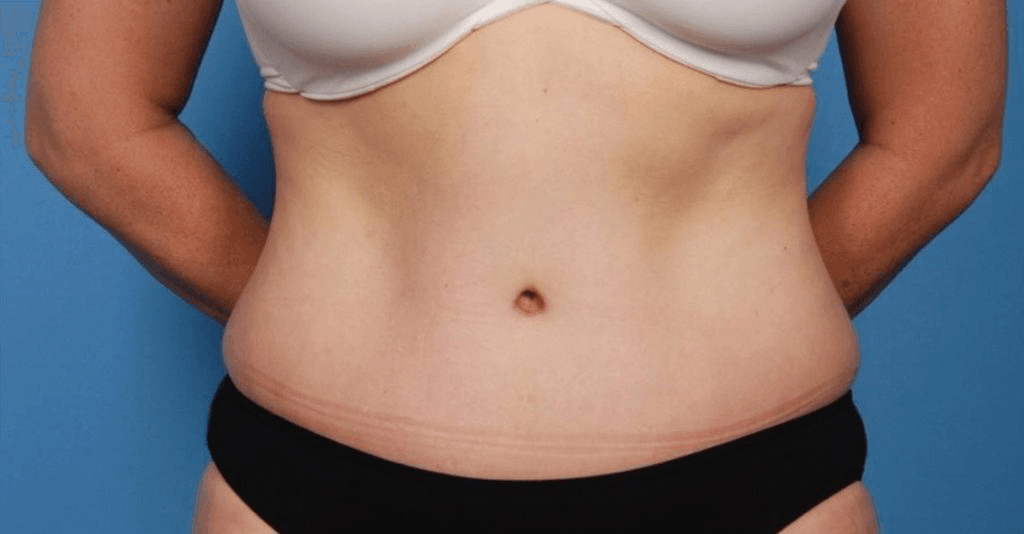 abdominoplastia