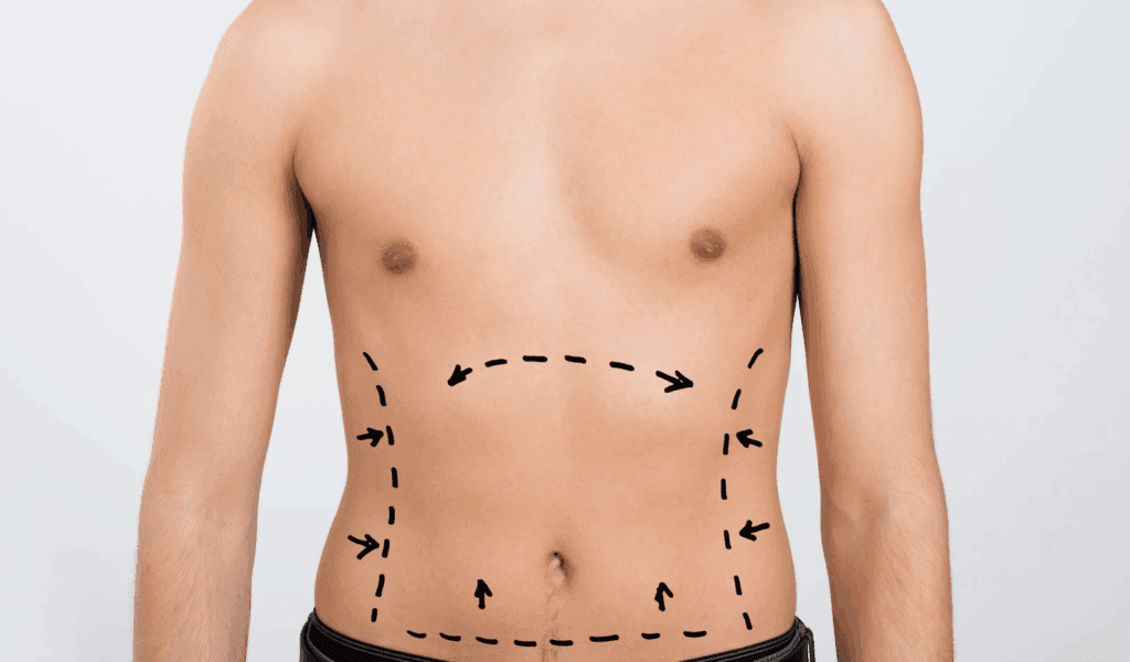 Risks of Body Contouring: What You Must Know Before Surgery 2