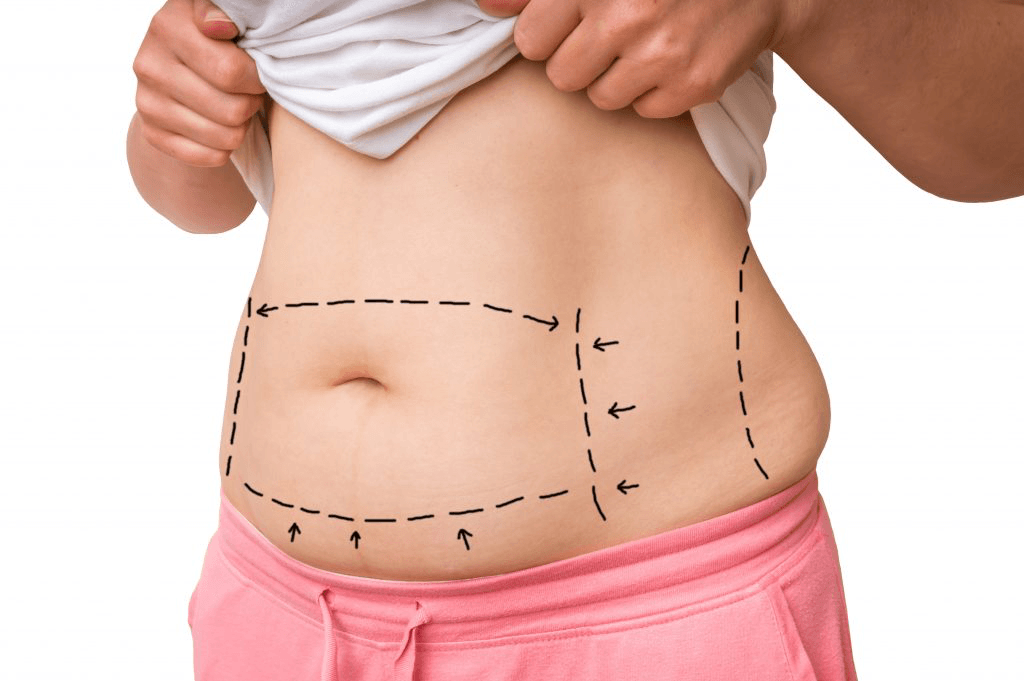 Liposuction Abroad: Post-Op Care & Follow-Up Guide (2025) 1