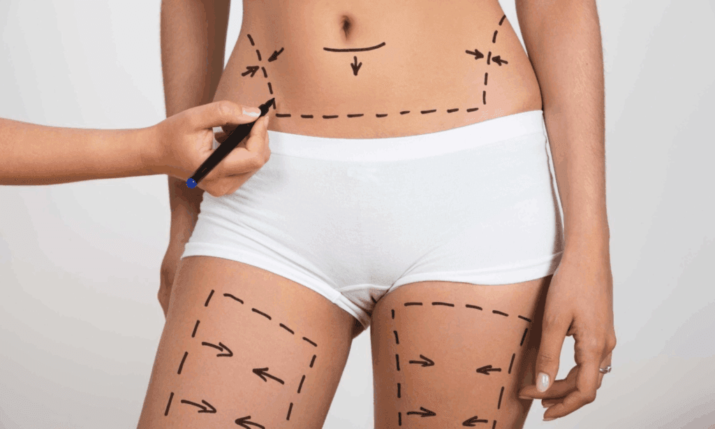 Liposuction Abroad: Post-Op Care & Follow-Up Guide (2025) 2