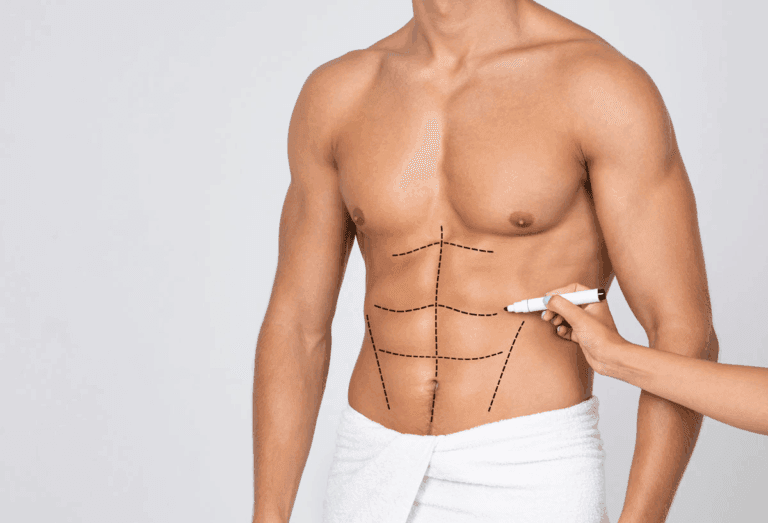 A person with drawn lines on their abdomen, indicating areas for potential cosmetic surgery, holding a marker.
