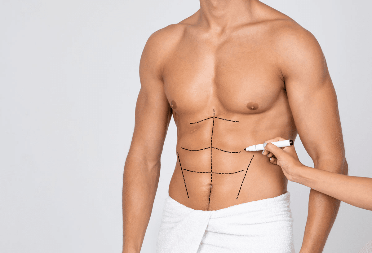 A person with drawn lines on their abdomen, indicating areas for potential cosmetic surgery, holding a marker.