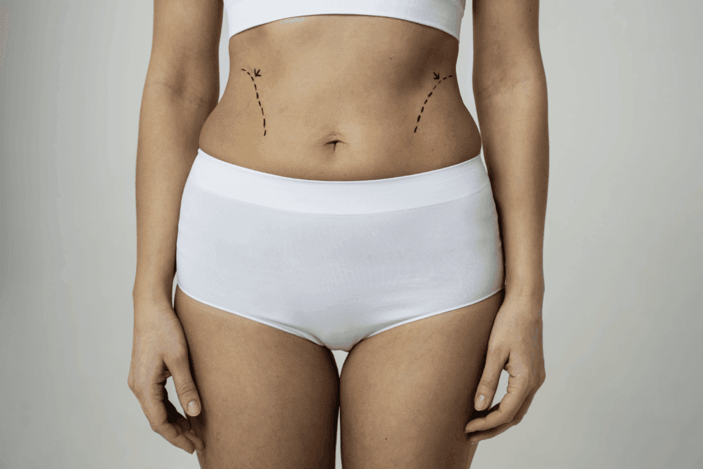 abdominoplastia