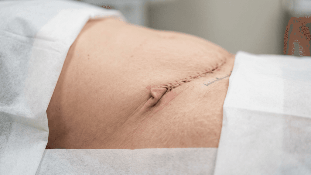 Dog Ears After Tummy Tuck