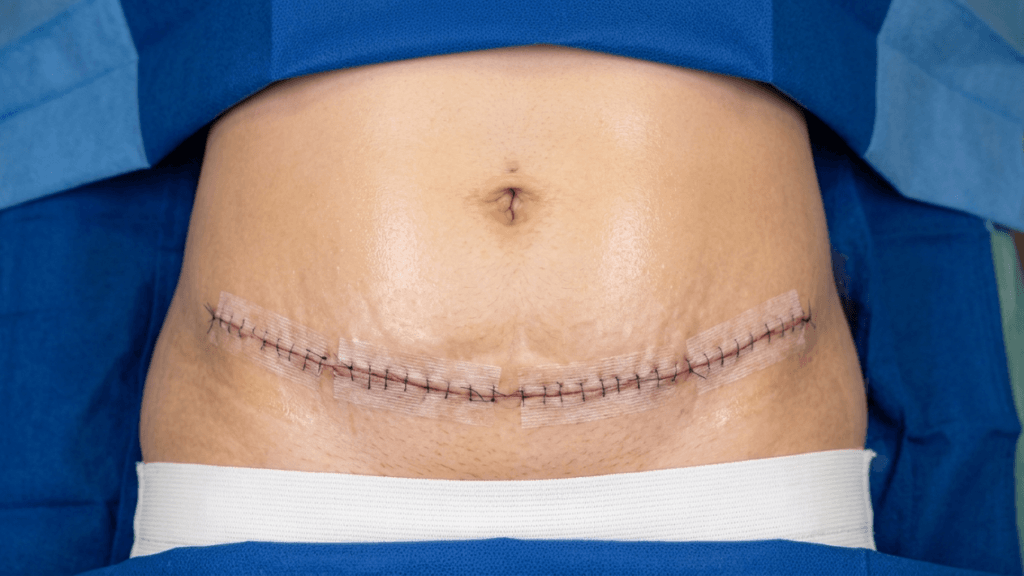 A close-up, high-angle medical photograph of a female patient's lower abdomen post-surgery. The image shows a horizontal surgical incision secured with sutures and covered by transparent adhesive surgical strips, located just above the pubic area. The skin displays natural texture, including faint stretch marks. The lighting is bright, clinical, and even, typical of an operating room setting. The patient is draped in blue sterile surgical cloths, and a white garment or bandage is visible at the bottom edge of the frame. The focus is sharp on the surgical site, highlighting the anatomical details of the abdominal wall.