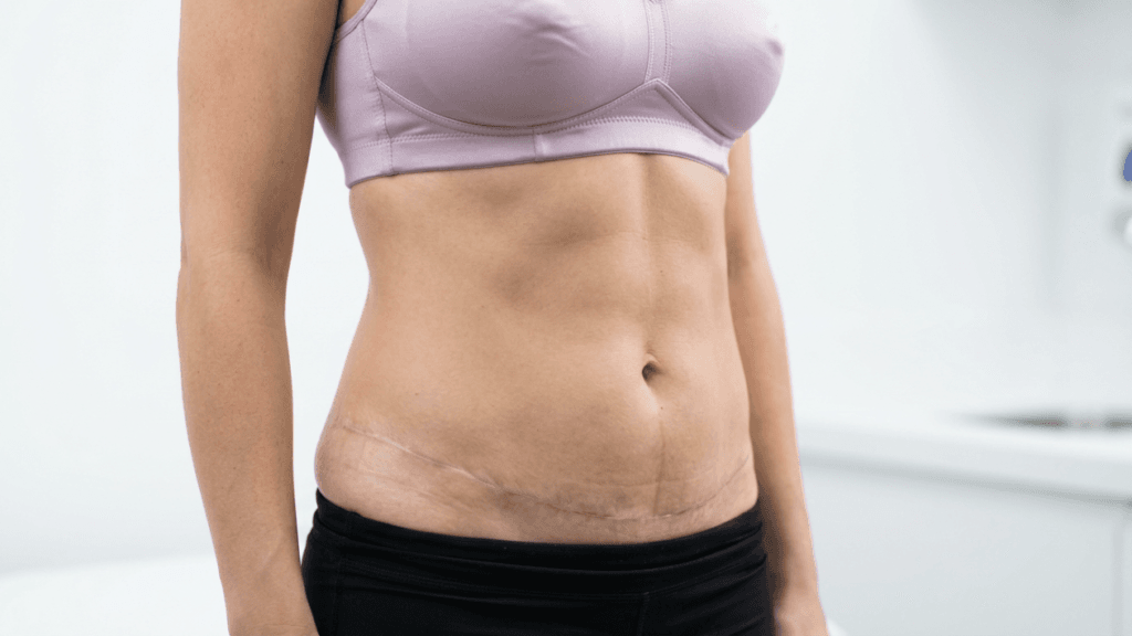 A medium close-up, brightly lit studio shot of a female torso showing the results of a tummy tuck procedure. The woman is wearing a light purple athletic bra and black leggings, standing in a clinical or medical office environment with a blurred white background. The camera angle is straight-on, focusing on her midsection. Her abdomen shows a horizontal surgical scar from a abdominoplasty. There is no makeup or facial features visible as the focus is purely on the anatomical result of the surgery.