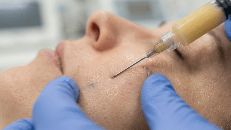 Close-up profile shot of a person receiving a facial fat grafting procedure. The person's face is positioned horizontally, with a syringe containing yellowish adipose tissue being injected into their cheek area by a practitioner wearing blue nitrile gloves. The lighting is bright and clinical, highlighting the skin's natural texture, while the background is softly blurred to emphasize the medical procedure. No makeup is visible on the subject's skin, which shows natural anatomical features. The camera angle is at eye-level, focusing intently on the point of injection.