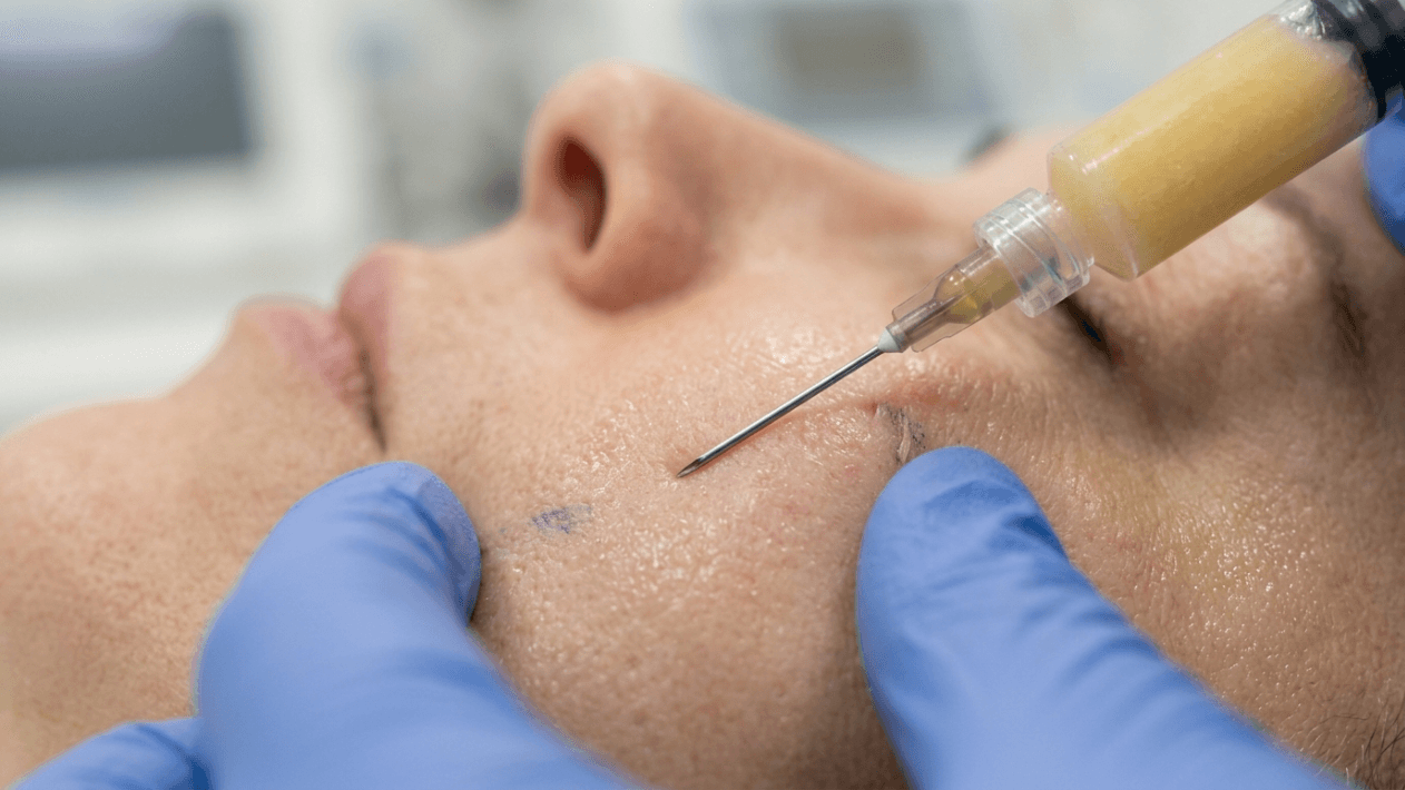 Close-up profile shot of a person receiving a facial fat grafting procedure. The person's face is positioned horizontally, with a syringe containing yellowish adipose tissue being injected into their cheek area by a practitioner wearing blue nitrile gloves. The lighting is bright and clinical, highlighting the skin's natural texture, while the background is softly blurred to emphasize the medical procedure. No makeup is visible on the subject's skin, which shows natural anatomical features. The camera angle is at eye-level, focusing intently on the point of injection.